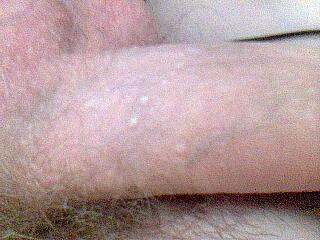 Bulky na penisu, Bulky, penisu