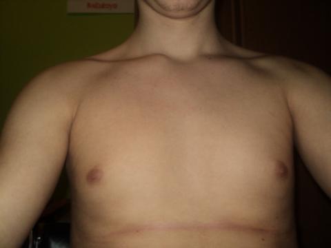 Gynekomastia áno/nie, Gynekomastia, áno/nie