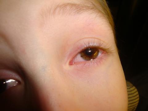 Pigmentace v oku u dítěte, Pigmentace, oku, u, dítěte