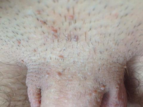 papiloma virus i bradavice papilom intern