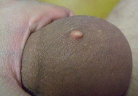 Větší kožní výrůstek na močovém měchýři, Větší, kožní, výrůstek, močovém, měchýři